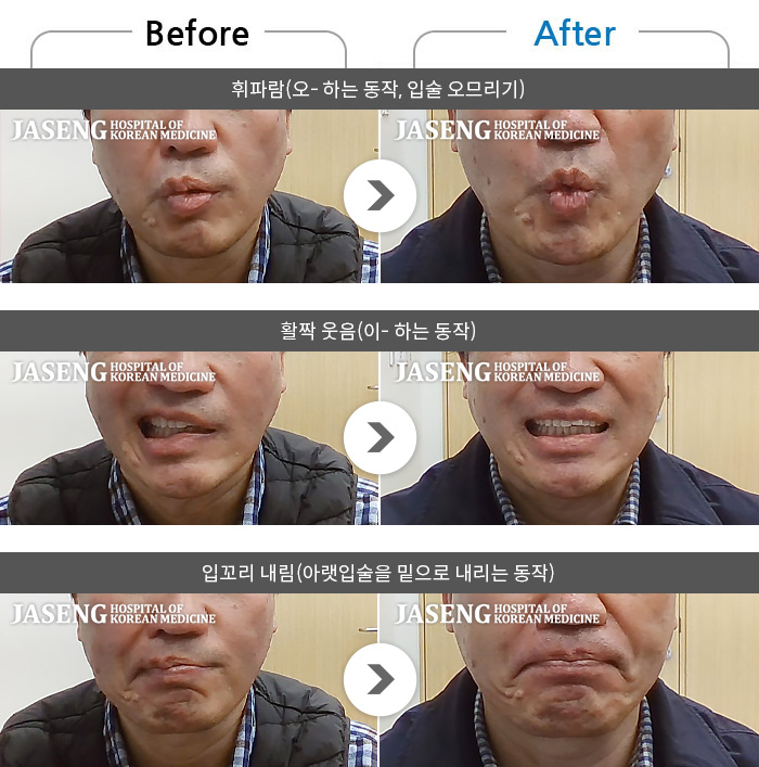 �ڻ��ѹ溴�� ġ���� �ȸ�Ű渶�� ġ����-���� �� ��Ʈ������ ���� ���� �ȸ鸶�� �߻��Ͽ����ϴ�.