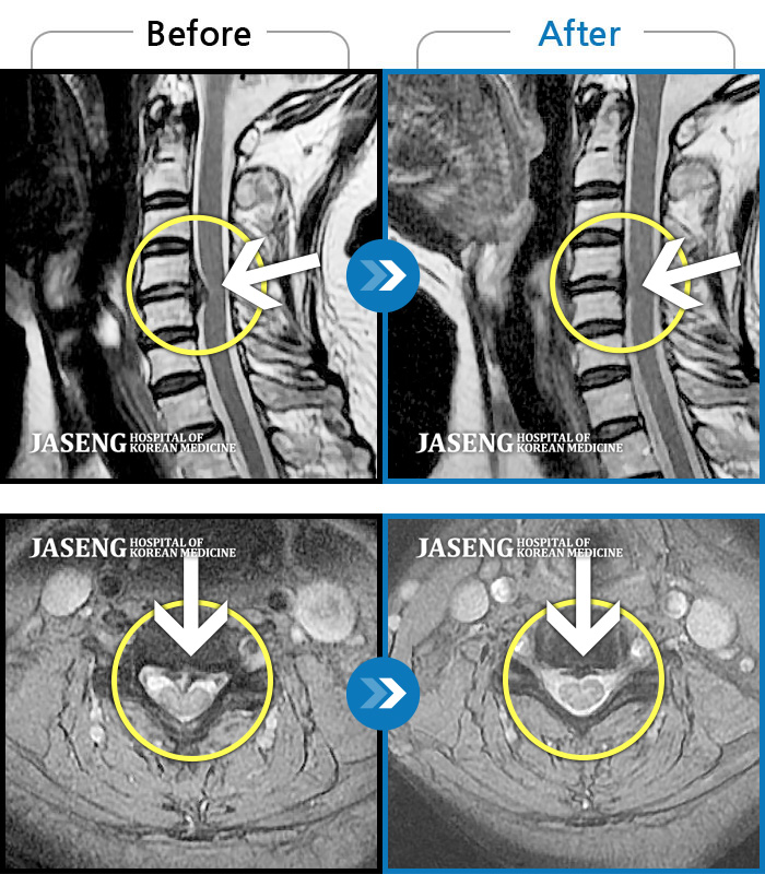 Ȼڻѹ溴 ġ MRI  ġ-   īӰ .