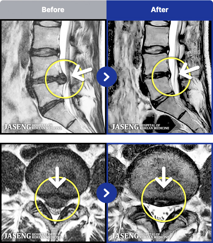 �ڻ��ѹ溴�� ġ���� MRI�� ���� ġ����-������ ���� �Ϻ� ���߿� ���� ������ �߻��Ͽ���, ���� �ٸ� �ٱ����� ���� ��������� ���Ƹ����� ������ ������ ���ݵǾ����ϴ�.