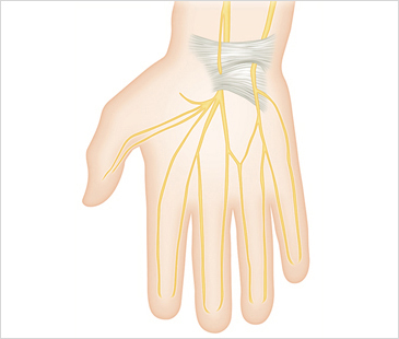 평촌자생한의원 기타관절질환 손목터널증후군-손목터널증후군에 관련된 이미지 입니다.