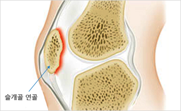 평촌자생한의원 무릎질환 슬개골연골연화증-슬개골 연골이 위치해 있는 무릎 설명 이미지