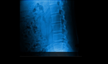 평촌자생한의원 허리질환 척추후만증-척추후만증에 관련된 이미지 입니다.
