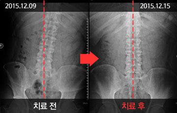 평촌자생한의원 청소년척추 체형교정&척추측만증- 치료 전후 사례 이미지