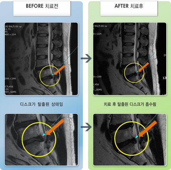 자생한방병원 치료사례 MRI로 보는 치료결과-좌측 요통, 좌측 둔부에서 종아리까지 통증이 심하여 바로 누워서 잠을 못잠