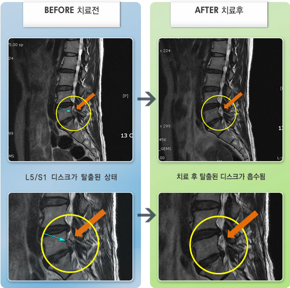 자생한방병원 치료사례 MRI로 보는 치료결과-허리 통증이 심하여 굽히거나 펴지 못하고 움직임이 자유롭지 못한 상태