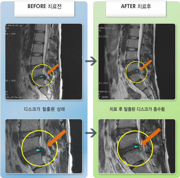 자생한방병원 치료사례 MRI로 보는 치료결과-허리 통증 및 좌측 엉치에서 종아리 후면으로 저린 느낌이 심해 일상생활이 불편하였다.
