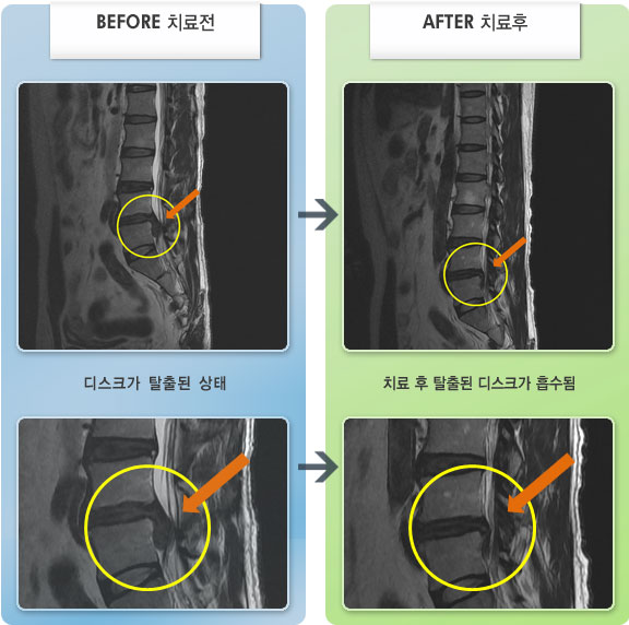 자생한방병원 치료사례 MRI로 보는 치료결과-보행시 어려움이 많았고 주로 앉거나 서서 일을 하는데 불편감이 심했었다.