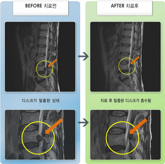 자생한방병원 치료사례 MRI로 보는 치료결과-혼자 서있지 못하여 부인의 부축을 받아 자생을 찾았다. 