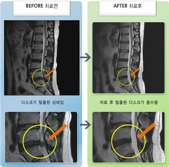 자생한방병원 치료사례 MRI로 보는 치료결과-앉았다 일어날때, 허리 숙일때 통증이 심한 상태