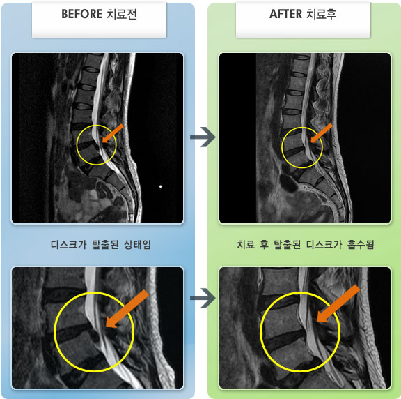 자생한방병원 치료사례 MRI로 보는 치료결과-허리디스크로 인한 허리 및 종아리 통증