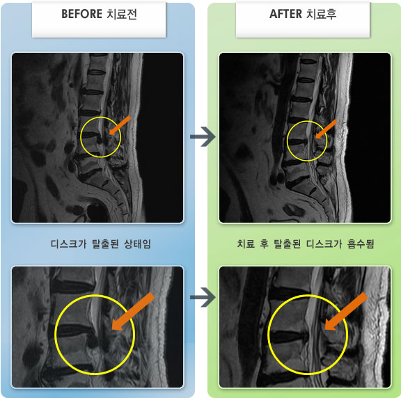 자생한방병원 치료사례 MRI로 보는 치료결과-허리 통증과 우측 다리 힘없는 느낌이 있었으나 6개월 치료 후 호전되었다.