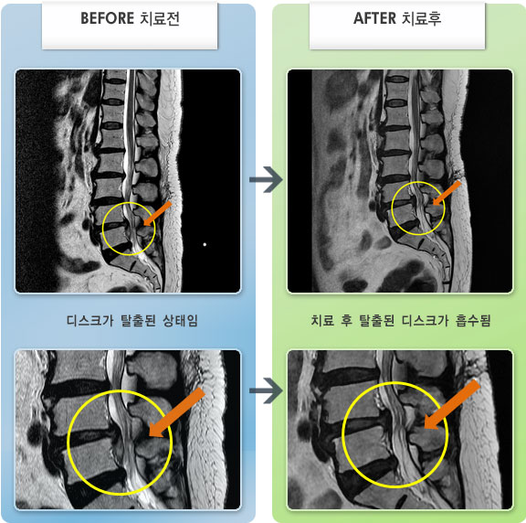 자생한방병원 치료사례 MRI로 보는 치료결과-허리디스크로 인한 양측 골반 및 좌측 발가락 통증