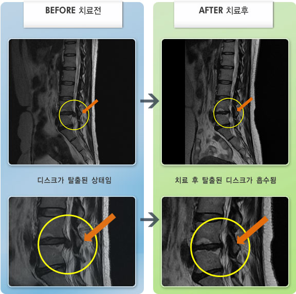 자생한방병원 치료사례 MRI로 보는 치료결과-허리디스크로 인한 허리 통증 및 우측 하지 통증