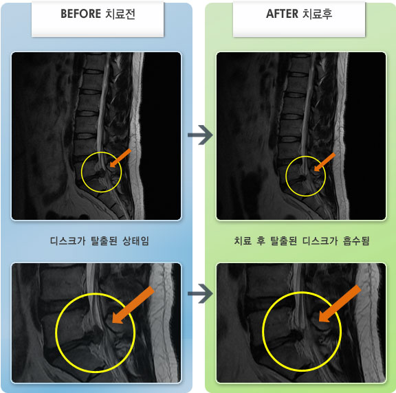 자생한방병원 치료사례 MRI로 보는 치료결과-허리와 왼쪽 엉치 뻐근하고 왼쪽 종아리 뒤에서 발바닥까지 저림이 심했다. 
