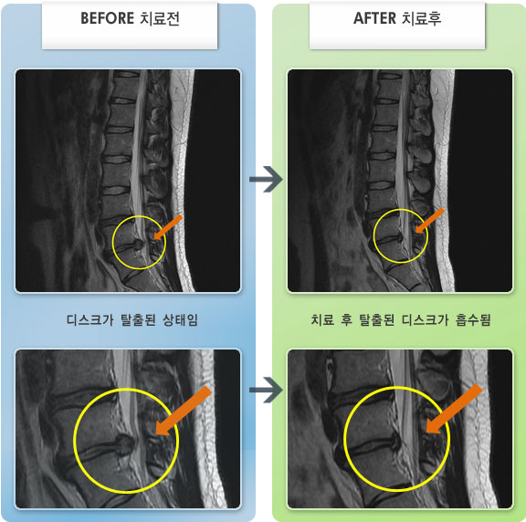 자생한방병원 치료사례 MRI로 보는 치료결과-허리디스크로 인한 좌측 엄지발가락 근력 저하