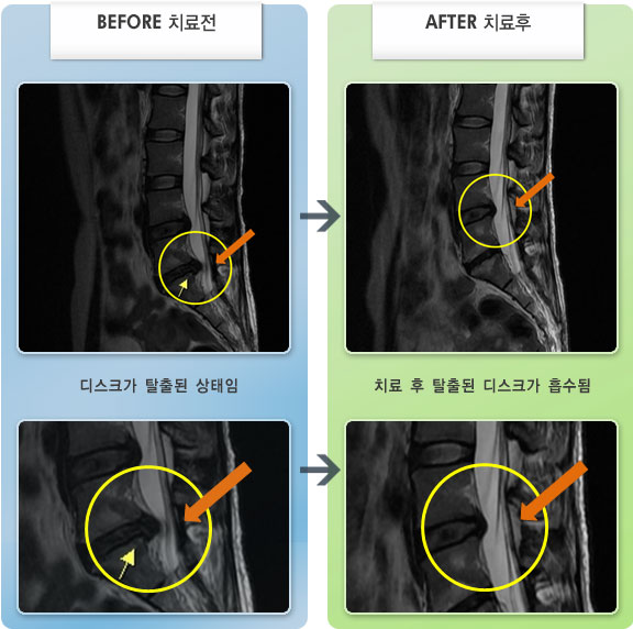자생한방병원 치료사례 MRI로 보는 치료결과-허리디스크로 인한 허리 및 왼쪽 다리 통증