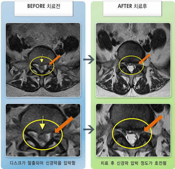 자생한방병원 치료사례 MRI로 보는 치료결과-허리디스크로 인한 보행시 종아리 통증
