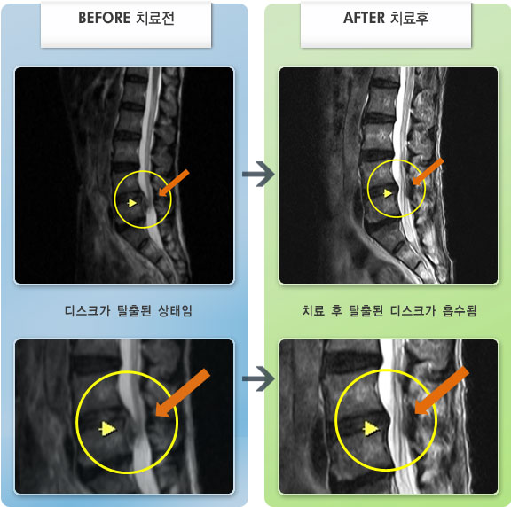 자생한방병원 치료사례 MRI로 보는 치료결과-허리디스크로 인한 오른쪽 다리 통증