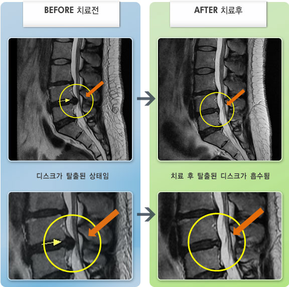 자생한방병원 치료사례 MRI로 보는 치료결과-허리디스크로 인한 허리 통증 및 우측 다리 통증