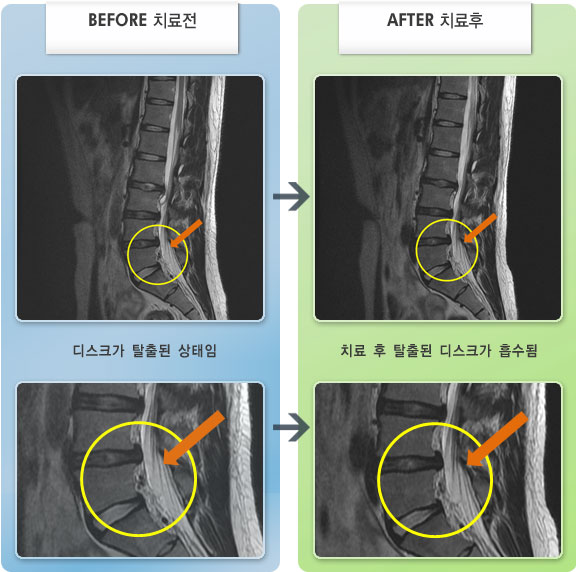 자생한방병원 치료사례 MRI로 보는 치료결과-오른쪽 허리와 오른쪽 다리 통증