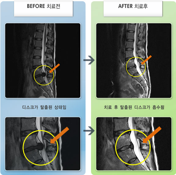 자생한방병원 치료사례 MRI로 보는 치료결과-허리와 오른쪽 엉치 통증