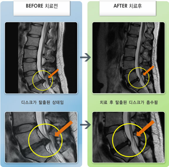 자생한방병원 치료사례 MRI로 보는 치료결과-왼쪽 엉치에서 발끝까지 방사통이 있음