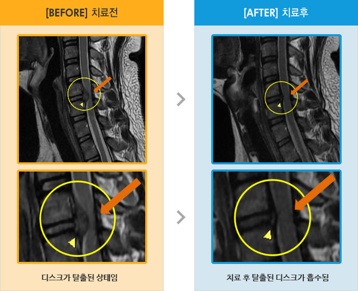 자생한방병원 치료사례 MRI로 보는 치료결과-왼쪽 목, 견갑골, 팔꿈치 통증