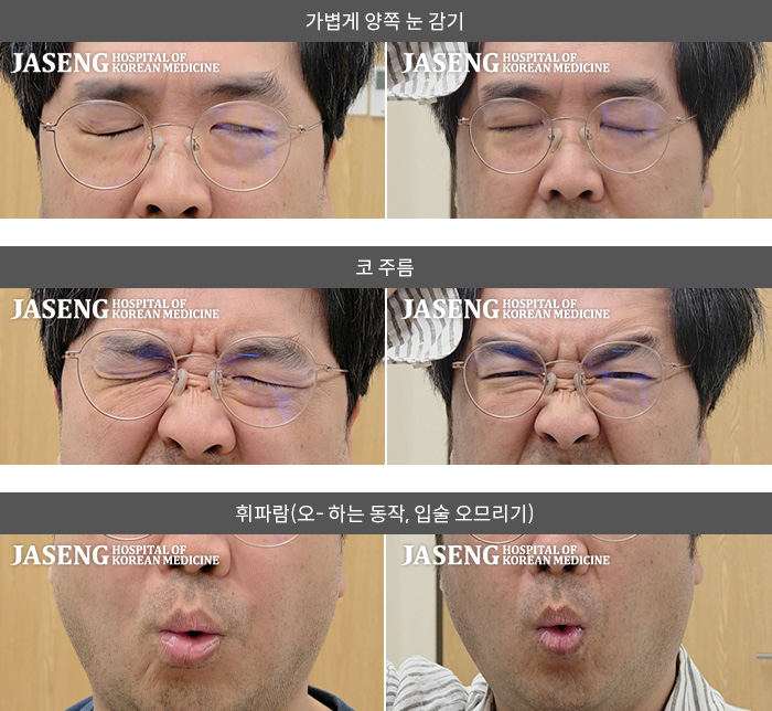 보라매자생한방병원-안면신경마비 치료 전후 사례