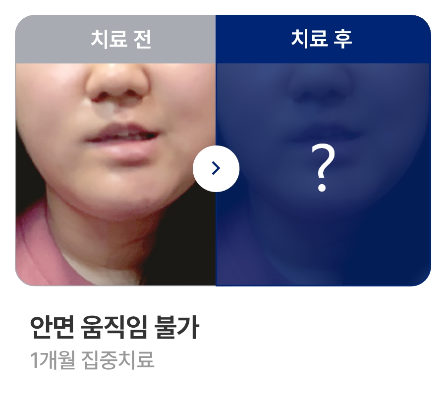 안면 움직임 불가 / 1개월 집중치료