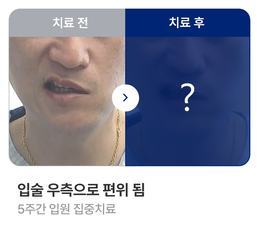 입술 우측으로 편위 됨 / 5주간 입원 집중치료